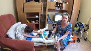 Первый этап гипсования Ярослава.Самочувствие Ярослава после гипсования. Сколько гипсов у нас ушло.